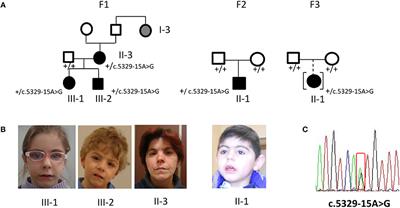 Recurrence and Familial Inheritance of Intronic NIPBL Pathogenic Variant Associated With Mild CdLS